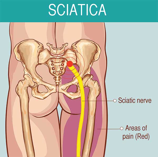 https://www.yehuwdah.com/imageuploads/pages/2019/03/25/sciatica-nerve-pain-treatment-in-alappuzha.jpg